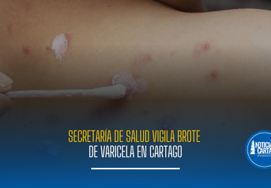 Secretaría de Salud vigila brote de varicela en Cartago