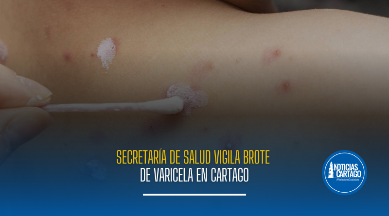 Secretaría de Salud vigila brote de varicela en Cartago